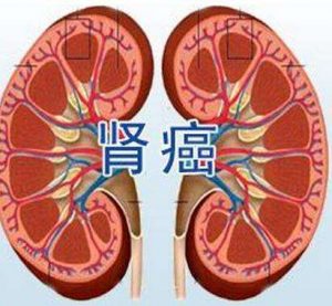 肾癌靶向药阿西替尼有哪些不良反应？
